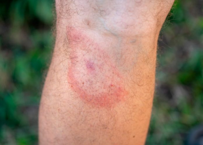 1 Confirman casos de fiebre hemorrágica de Crimea-Congo en España