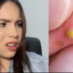 «Gracias a las espinillas» mujer descubre infidelidad de su pareja "Gracias a las espinillas" mujer descubre infidelidad de su pareja