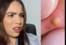 «Gracias a las espinillas» mujer descubre infidelidad de su pareja "Gracias a las espinillas" mujer descubre infidelidad de su pareja
