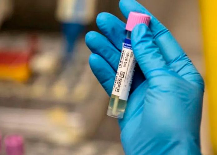 ¡Le llovió! Detectan en Italia COVID y VIH a un mismo paciente