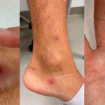 ¡El mismo día! Le detectan viruela del mono, VIH y covid en Italia