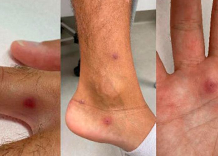 11111 ¡El mismo día! Le detectan viruela del mono, VIH y covid en Italia