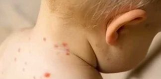 "Gripe del tomate": La dolorosa enfermedad que afecta a niños