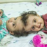 Médicos en Brasil logran separar siameses unidos por la cabeza 2 gemelos siameses en Brasil son sometidos a 7 cirugías