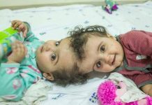 Médicos en Brasil logran separar siameses unidos por la cabeza 2 gemelos siameses en Brasil son sometidos a 7 cirugías
