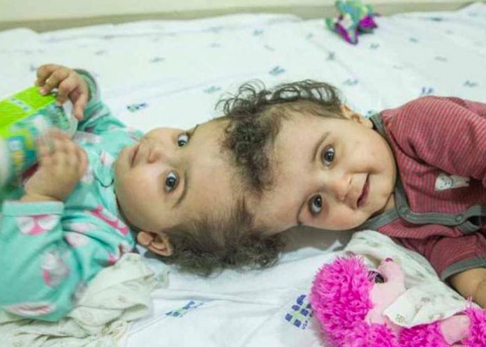 2 gemelos siameses en Brasil son sometidos a 7 cirugías