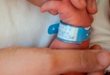 Insólito nacimiento de bebé con un cuerno en vez de piernas en la India