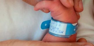 Insólito nacimiento de bebé con un cuerno en vez de piernas en la India