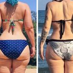 Lipedema: Enfermedad en las mujeres que no sabías