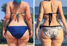 Lipedema: Enfermedad en las mujeres que no sabías Lipedema: Enfermedad en las mujeres que no sabías