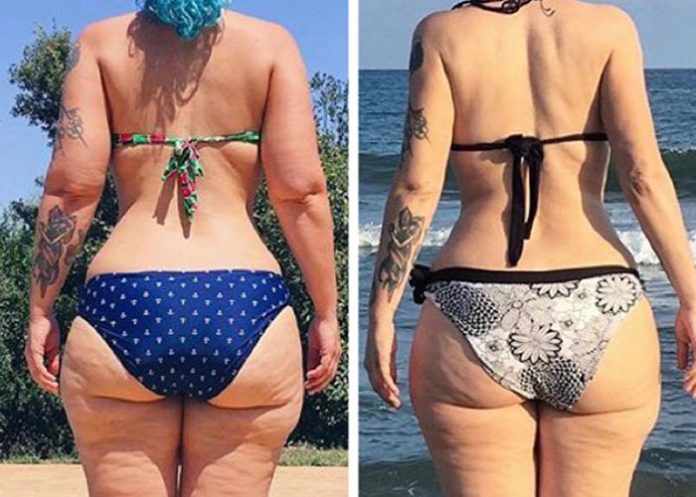Lipedema: Enfermedad en las mujeres que no sabías