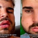 Amaneció con la cara deformada por la muela extraída