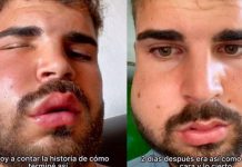 Cuidado…Fue al dentista por fuerte dolor de muela y quedó irreconocible Amaneció con la cara deformada por la muela extraída