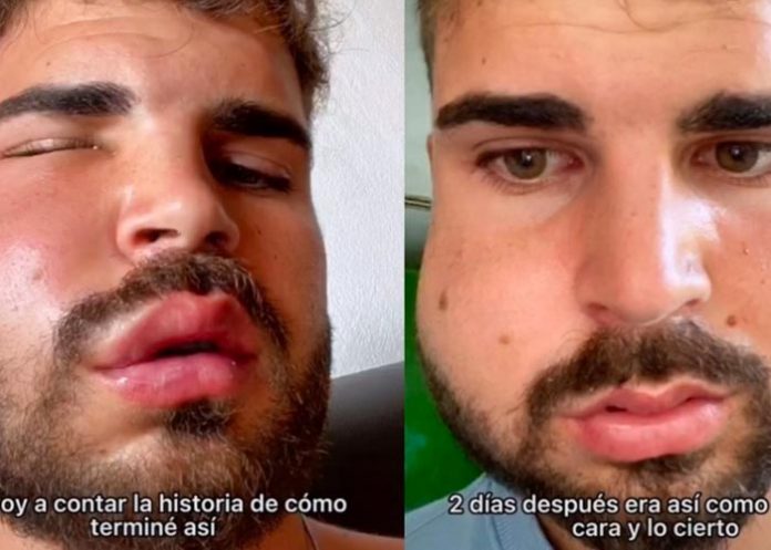 Amaneció con la cara deformada por la muela extraída