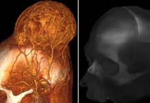 Con gran éxito neurocirujanos de Rusia extraen tumor cerebral maligno Neurocirujanos de Rusia extirparon un enorme tumor