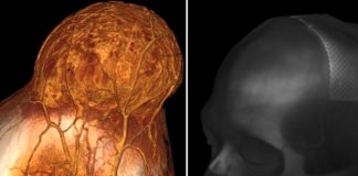 Neurocirujanos de Rusia extirparon un enorme tumor 