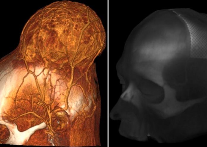 Neurocirujanos de Rusia extirparon un enorme tumor 
