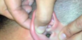 ¡Asqueroso! Joven tenía un "nido" de cucarachas en el oído (Video)