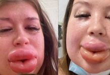 «La vanidad la envió al hospital»: Mujer termina mal por inyectarse químicos "La vanidad la envió al hospital": Mujer termina mal por inyectarse químicos