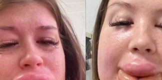 "La vanidad la envió al hospital": Mujer termina mal por inyectarse químicos