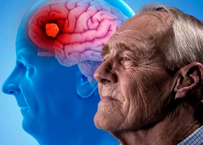 Ancianitos que tuvieron Covid-19 con mayor riesgo de padecer Alzheimer