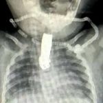 ¡Viva de milagro! Bebé se traga cortauñas por accidente en la India