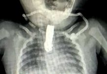¡Viva de milagro! Bebé se traga cortauñas por accidente en la India