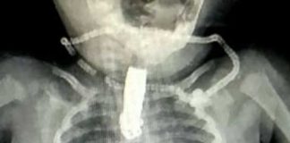 ¡Viva de milagro! Bebé se traga cortauñas por accidente en la India