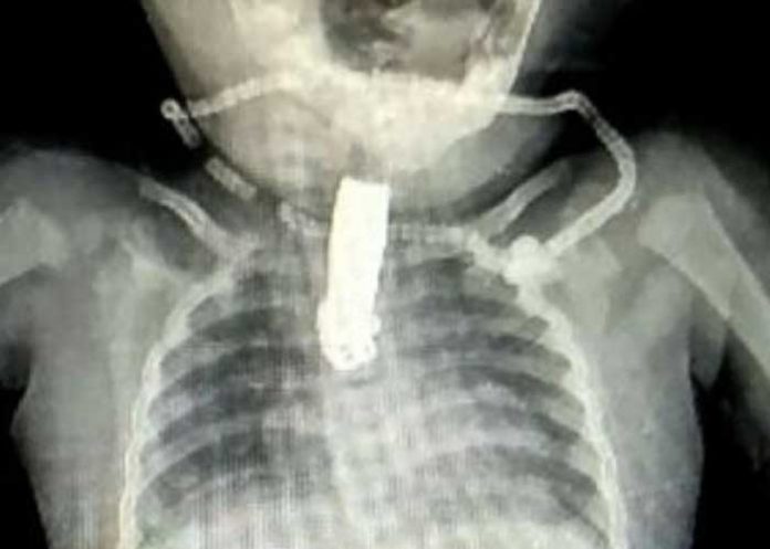 1 ¡Viva de milagro! Bebé se traga cortauñas por accidente en la India