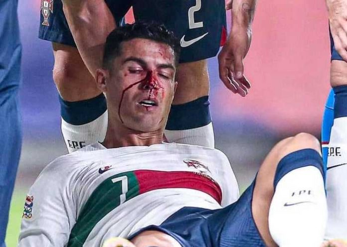1 ¡Bañado en sangre! Cristiano Ronaldo queda tendido en el campo