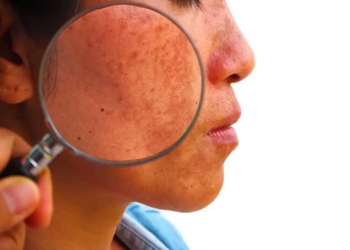 Uno de los aliados para aclarar la piel es la vitamina B3