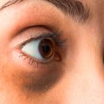 Mitos y verdades médicas detras de las ojeras Mitos y verdades médicas detrás de las ojeras