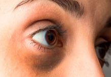 Mitos y verdades médicas detras de las ojeras Mitos y verdades médicas detrás de las ojeras