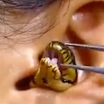 La víbora viva se resistía a salir de la oreja de una chica