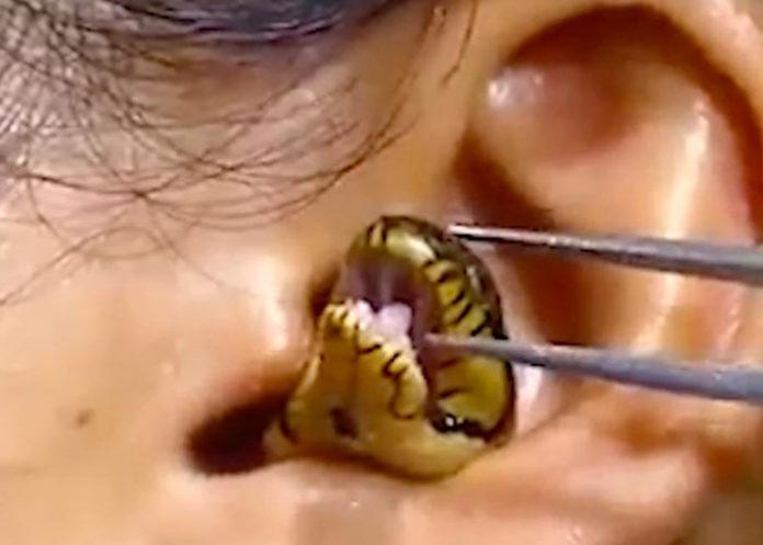 La víbora viva se resistía a salir de la oreja de una chica