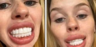 Mujer se arrepiente de su cirugía: "Me veo como un caballo"