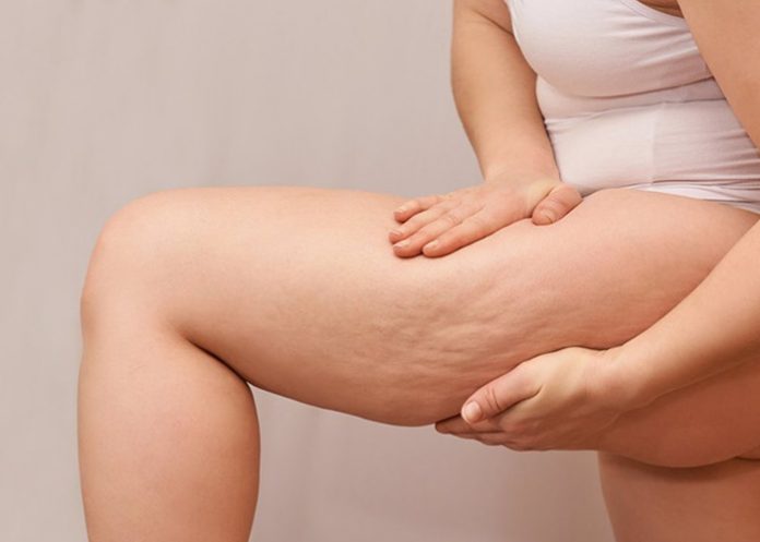 ¿La celulitis es un problema estético o es signo de enfermedad? Algunos tips para prevenirla