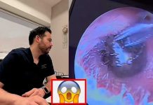 ¿Cómo llegó ahí? Extraen una pieza de arete del oído de una mujer (Video) ¿Cómo llegó ahí? Extraen una pieza de arete del oído de una mujer (Video)