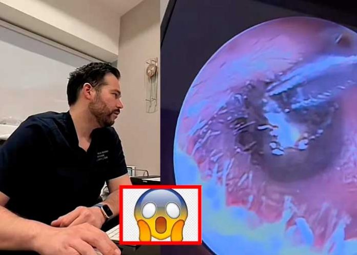 ¿Cómo llegó ahí? Extraen una pieza de arete del oído de una mujer (Video)