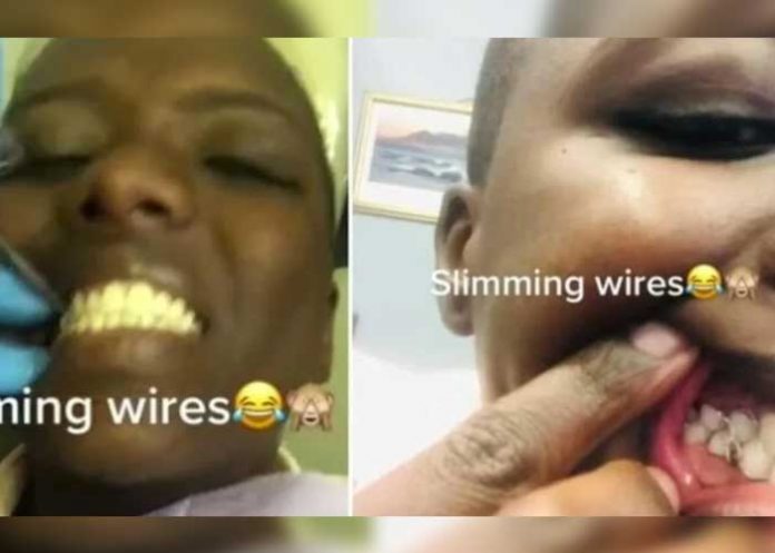 ¡Locura total! Jóvenes de África se cosen la boca para bajar de peso