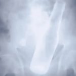 Ladrones «sin escrúpulos» ponen botella en el ano a un señor de 79 años Ladrones ponen botella en el ano de un hombre de 79