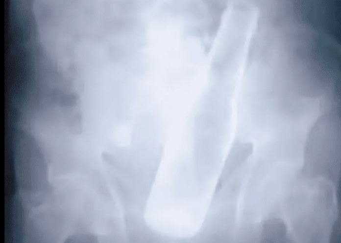 Ladrones ponen botella en el ano de un hombre de 79