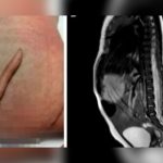 Bebé nació con una cola en un Hospital de México