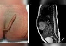 Bebé nació con una cola en un Hospital de México Bebé nació con una cola en un Hospital de México
