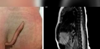 Bebé nació con una cola en un Hospital de México