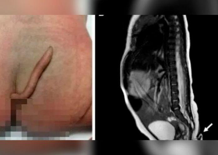 Bebé nació con una cola en un Hospital de México