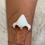 Insólita razón por la que mujer en Francia dejó crecer una nariz en el brazo Insólita razón por la que mujer en Francia dejó crecer una nariz en el brazo