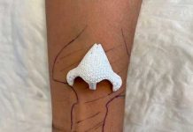 Insólita razón por la que mujer en Francia dejó crecer una nariz en el brazo Insólita razón por la que mujer en Francia dejó crecer una nariz en el brazo