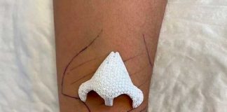 Insólita razón por la que mujer en Francia dejó crecer una nariz en el brazo