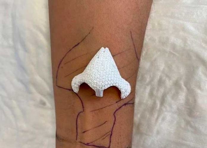 francia1 Insólita razón por la que mujer en Francia dejó crecer una nariz en el brazo